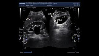 Ultrasound Video showing two stones in ureter [upl. by Siron]