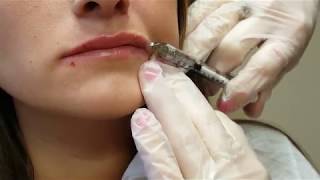 Lip Filler Experience  One Syringe of Juvederm [upl. by Elon462]