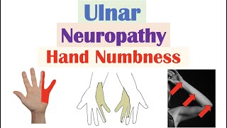 Ulnar Neuropathy amp Numbness in the Hand  Causes Signs amp Symptoms Diagnosis Treatment [upl. by Dupaix]