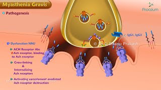 Myasthenia Gravis Etiology  Pathogenesis Classification  Clinical features Diagnosis Treatment [upl. by Emorej]