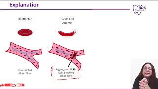 NEET MDS 2023 Pathology  Sclerotic Dentin [upl. by Giamo350]