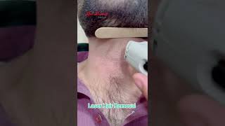 Laser Hair Removal getsmarthairclub viralvideo viralshort [upl. by Naves546]