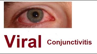 Viral Conjunctivitis [upl. by Utir]