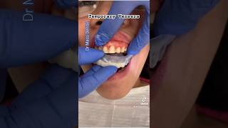 Temporary Veneers tooth vlog [upl. by Niro]