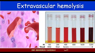 Lecture 213 Extravascular hemolysis [upl. by Feliza347]