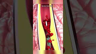 Heart stent Kaise Kaam Karta Hai  Vitalview3D Animation 3danimation shorts trending science [upl. by Nosille257]