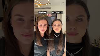 BOTOX VS NO BOTOX antiaging botulinumtoxin [upl. by Kcaj]