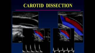 Non Atherosclerotic pathology of the Carotid Arteries [upl. by Ahtnahc]