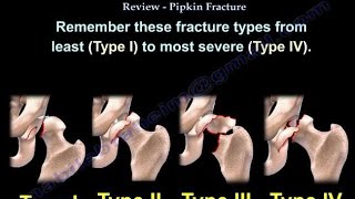 Femoral Head Fracture Review Pipken Fracture  Everything You Need To Know  Dr Nabil Ebraheim [upl. by Yboc996]