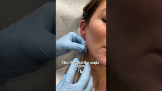 Jawline Filler transformation fillers [upl. by Yblehs595]