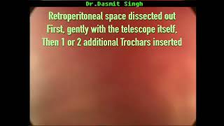 PUJ Obstruction  Retroperitoneoscopic Assisted Pyeloplasty RAP [upl. by Amihc]