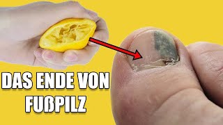 Dieses Hausmittel entfernt lästigen Fuß und Nagelpilz [upl. by Attenaz]