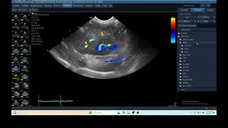 IQ 279 LIVER ULTRASOUND HEPATOMA ECHOPAC ANALYSIS ECHOCARDIOGRAPHY COLOR FLOW MAPING [upl. by Aynna]