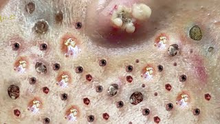 Blackhead Removal With Sac Dep Spa 100074051 [upl. by Ahsenev519]