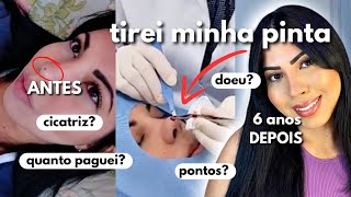 Minha CIRURGIA PLÁSTICA PARA RETIRAR PINTA ♡ Jéssica Cavalcanti [upl. by Guglielma]