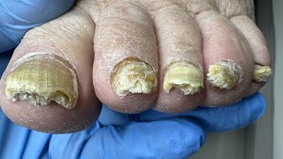 Treatment of thick yellow nails with a fungal infection Blood vessels have grown into the nail [upl. by Campman]