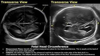 How To Measure Fetal Head Circumference HC On Ultrasound  Biometric Parameters  Obstetric USG [upl. by Alohs35]