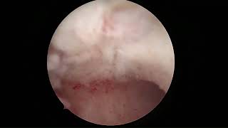 HYSTEROSCOPIC CURETTAGE [upl. by Odette9]