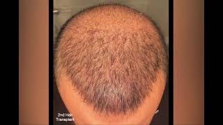 DHI Hair Transplant  14 weeks result  4300 graft [upl. by Sup]