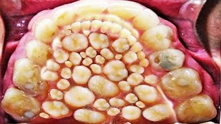 2016 World Record for Most Teeth amp Hyperdontia [upl. by Sucramaj]