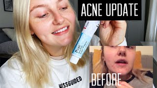 ACNE UPDATE  Duac gel  Rhiannon Mair [upl. by Seda]