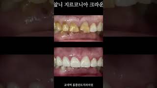 앞니 지르코니아 크라운 Zirconia Crown 앞니크라운깨진앞니앞니교모앞니마모앞니파절zirconiacrown [upl. by Lleryt664]