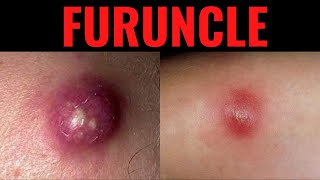 What is Furuncle Furuncle Boil DefinitionCauses Symptoms Risk Factors USMLE [upl. by Astrid]