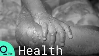 Monkeypox Outbreak What to Know About Virus Symptoms and More [upl. by Anead]