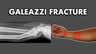 Galeazzi Fracture Dislocation Clinical Features Treatment and Complications [upl. by Harwill]