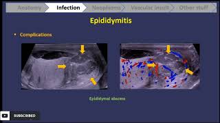 scrotal ultrasound  everything u should know  part 1 [upl. by Reimer]