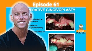 Ep 61  Do you recommend electrosurgery for cases of gingival hyperplasia [upl. by Elcarim431]