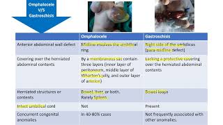 Omphalocele vs Gastroschisis  Spot Diagnosis  6  Pediatrics [upl. by Assena975]