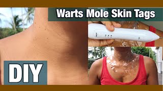 HOW TO REMOVE SKIN TAGS AT HOME FAST  Does Claritag Work My Honest Review [upl. by Morgenthaler]