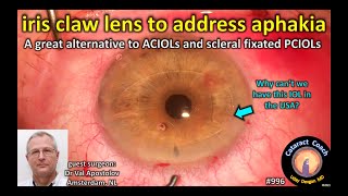 Iris claw lens to address aphakia Artisan IOL Wörst IOL [upl. by Elish]