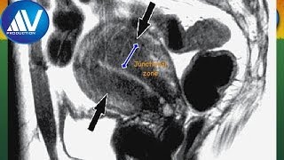 Adenomyosis part 2 [upl. by Celine]