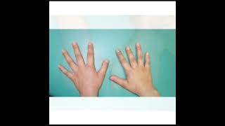 Brachydactyly Treatment  Symptoms and Causes  Diagnosis  Prevention health [upl. by Etterb457]