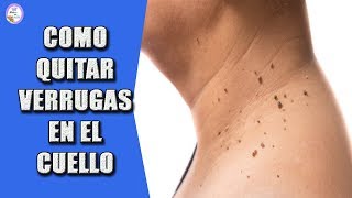 COMO QUITAR VERRUGAS EN EL CUELLO [upl. by Kelsey]