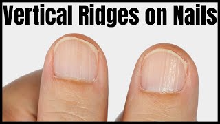 Vertical Ridges on Nails Causes Signs and Treatment [upl. by Esyak875]