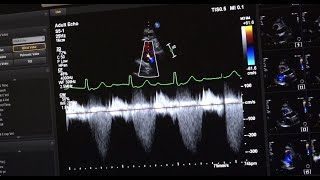 Waves of Hope Cardiac Ultrasound Campaign [upl. by Haiel]