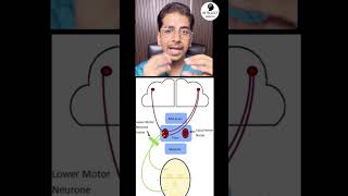 Bell’s palsy Where is the lesion UMN or LMN bellspalsy neurology shorts [upl. by Allyn]