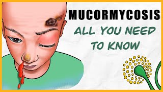 Mucormycosis microbiology types signs amp symptoms diagnosis treatment [upl. by Humph193]