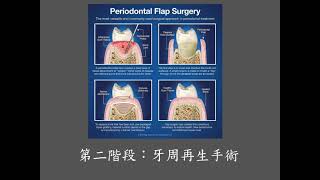 牙周病治療的流程 [upl. by Gibbeon]