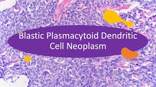 Blastic Plasmacytoid Dendritic Cell Neoplasm  learn in 10 minutes [upl. by Notsnhoj]