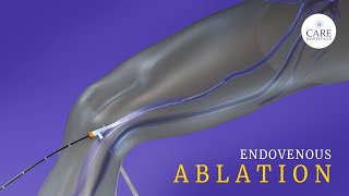 What is Endovenous Laser Ablation CARE Hospitals [upl. by Portwine]