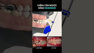 Cp pharmacist braces orthodontics shortvideo dentalclinic anatomy duet doctor braces pharma [upl. by Nosnevets]