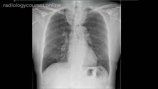 What is cervicothoracic sign [upl. by Neirol]