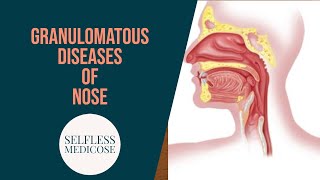 GRANULOMATOUS DISEASES OF NOSE part 1 Rhinoscleroma and syphylis in detail [upl. by Ielak682]