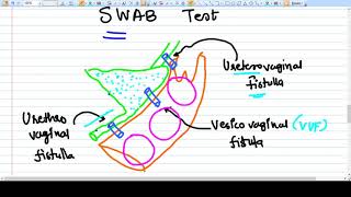 Swab Test  Urinary Fistula [upl. by Hanonew]