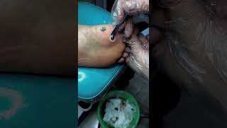 Treatment Callus and Dead skin Ep55 Sheng Clinic [upl. by Anoid738]