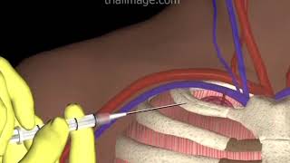 Subclavian Vein Access  Hypovolemic Patient  Animation by Cal Shipley MD [upl. by Rhoads]